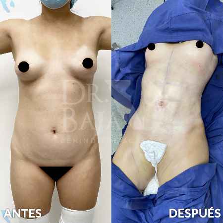 Lipoescultura HD con Lipomarcación-1