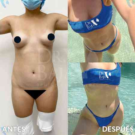 Lipoescultura HD con Lipomarcación-7