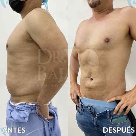 Lipoescultura HD con Lipomarcación-9