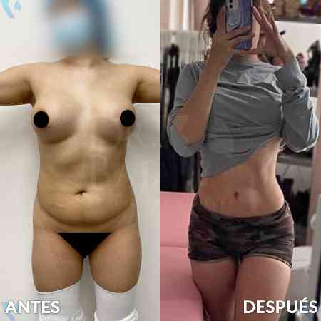 Lipoescultura HD con Lipomarcación-11