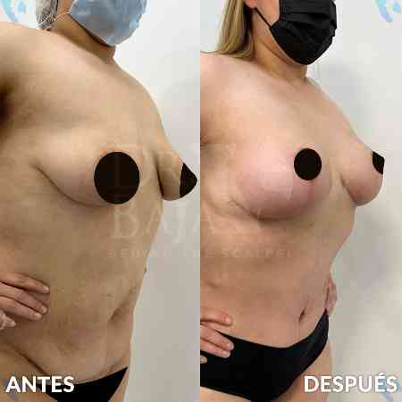 Mastopexy-2