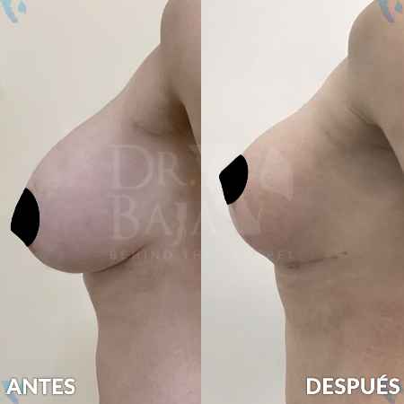 Mastopexy-8
