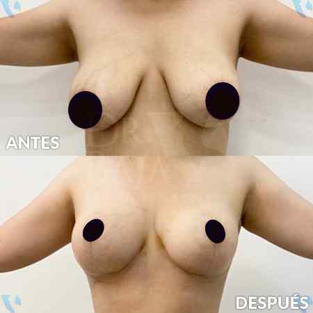 Mastopexy-10