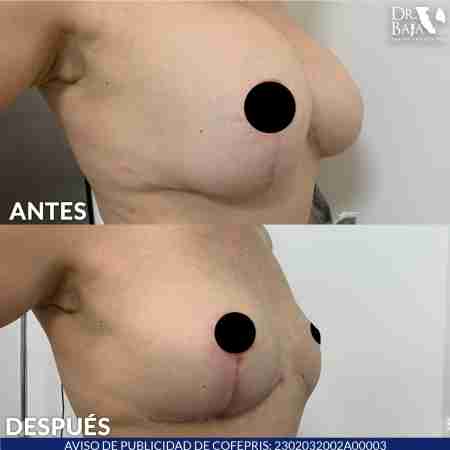 Mastopexy-12