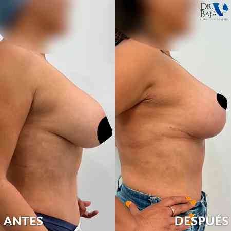 Mastopexy-14