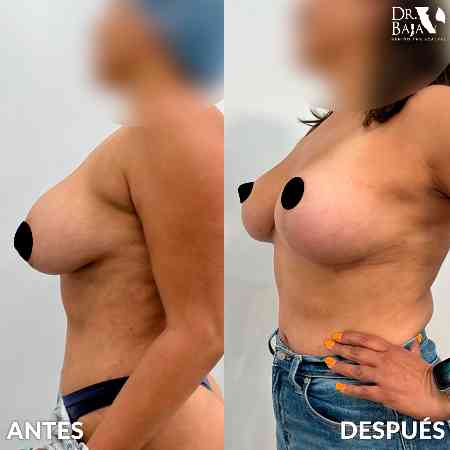 Mastopexy-15