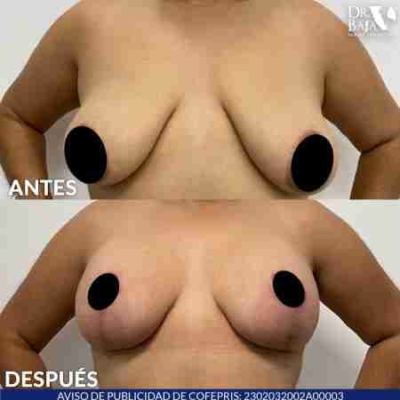 Mastopexy-20