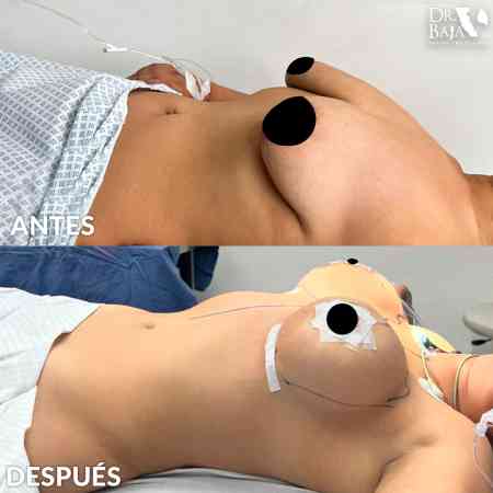 Mastopexy-21