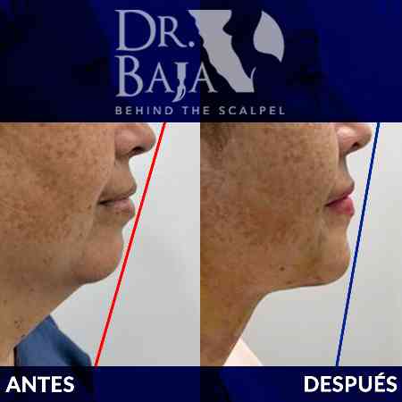 Mentoplastia-1