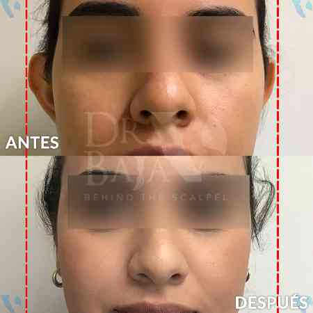 Otoplasty-1