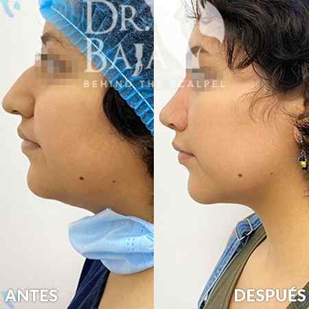 Double Chin and Neck Liposuction-1