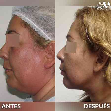 Double Chin and Neck Liposuction-5