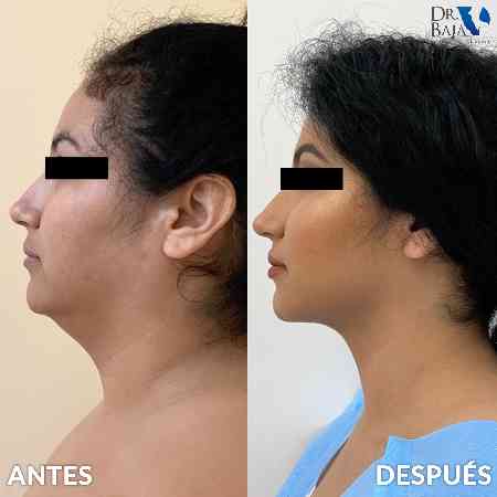 Double Chin and Neck Liposuction-6