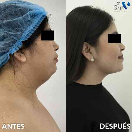 Double Chin and Neck Liposuction-7
