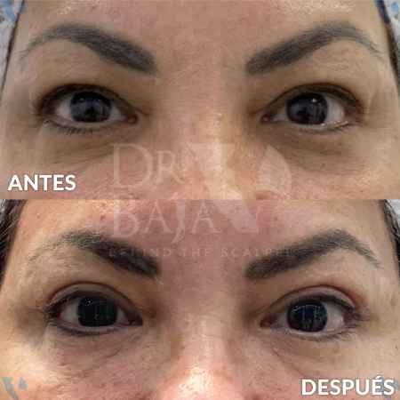Blefaroplastia-1