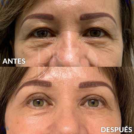 Blefaroplastia-2