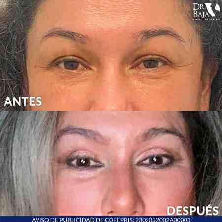 Blefaroplastia-6