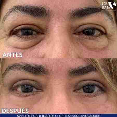 Blepharoplasty-11