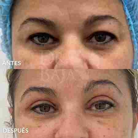 Blepharoplasty-12