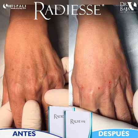 Radiesse-1