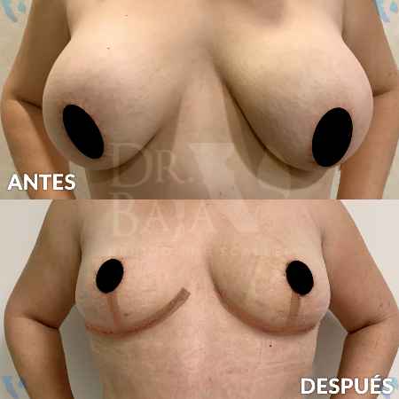 Reducción de Senos-1