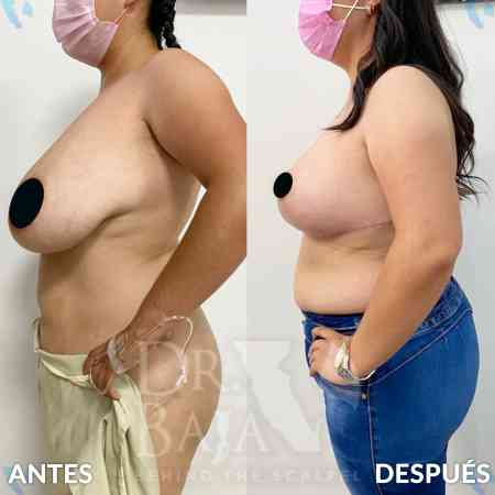 Breast Reduction-2