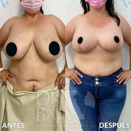 Reducción de Senos-3