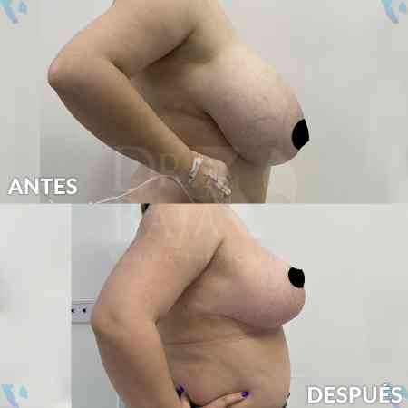 Reducción de Senos-5