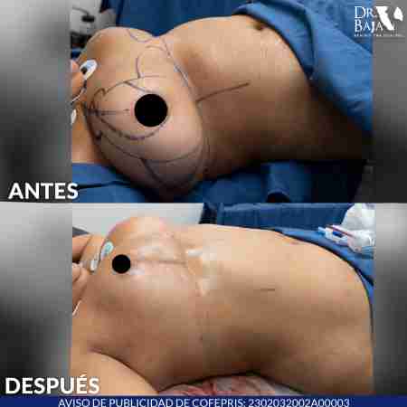 Reducción de Senos-9