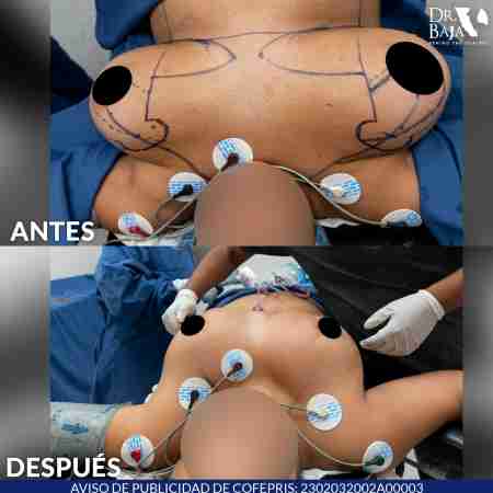 Reducción de Senos-10