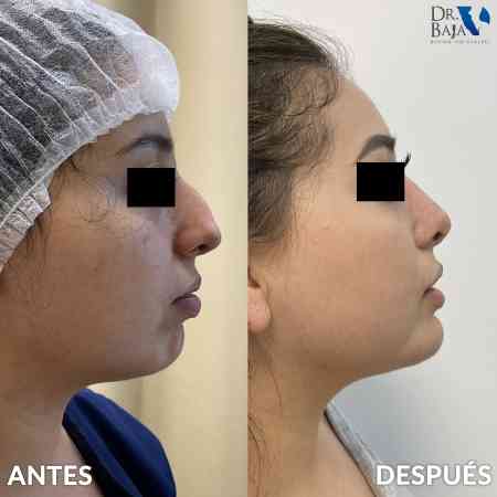 Rhinoplasty-1