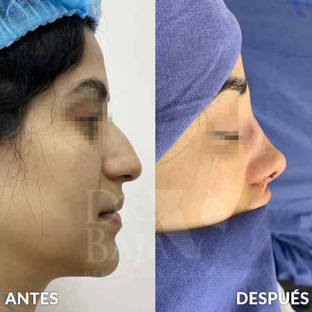 Rhinoplasty-6