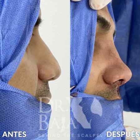 Rhinoplasty-8