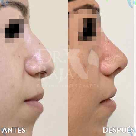 Rhinoplasty-7