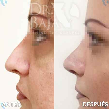 Rhinoplasty-8