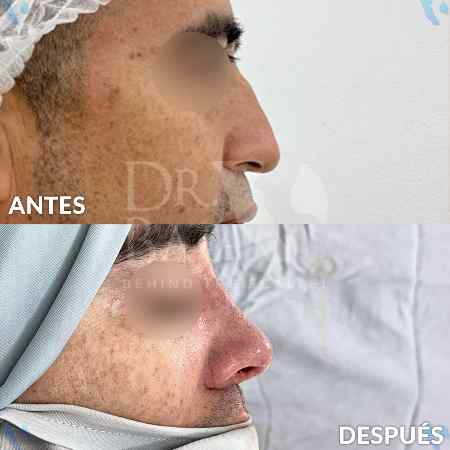 Rhinoplasty-12