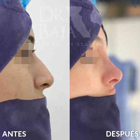 Rhinoplasty-10