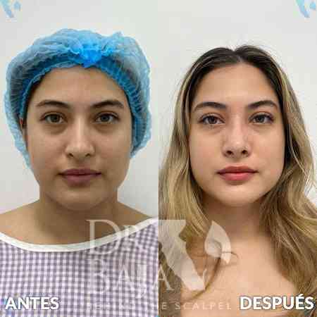 Rhinoplasty-13