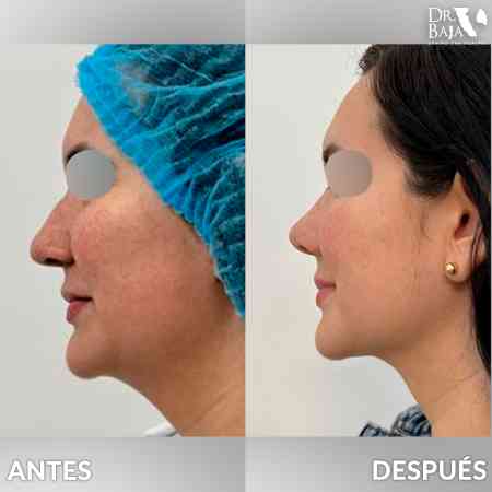 Rhinoplasty-16