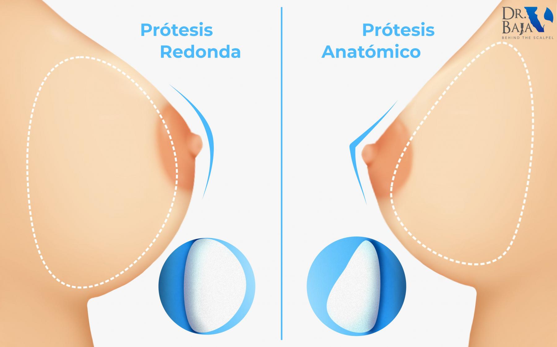 Prótesis