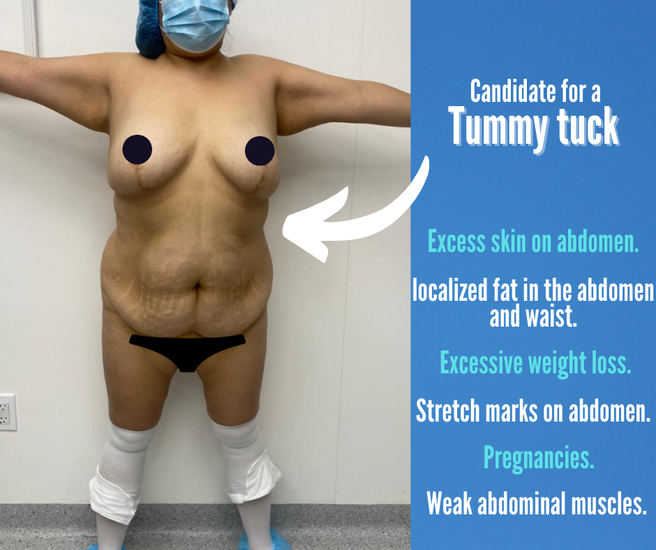 candidate for a tummy tuck