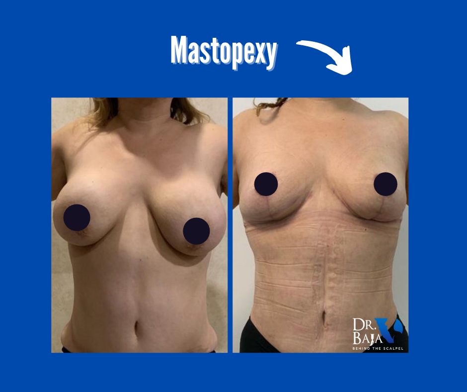 Mastopexy